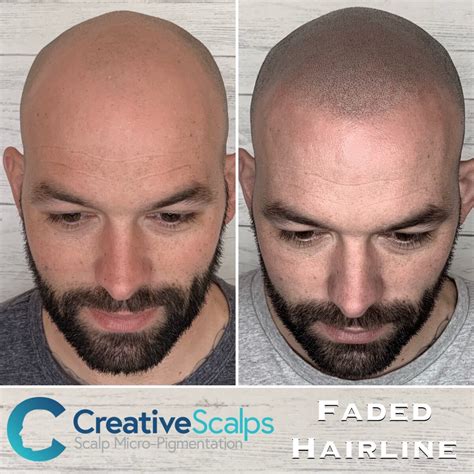 smp bugil|Best Scalp Micropigmentation 